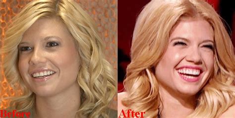 chanel west coast fake teeth before and after|chanel west coast teeth fixed.